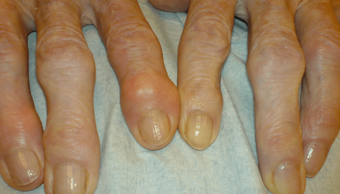 pain in the joints of the fingers with osteoarthritis
