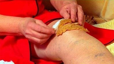 Compresses for arthrosis of the knee joint
