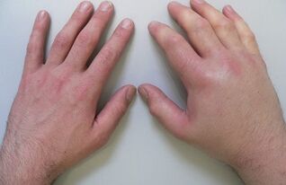 arthralgia as a cause of pain in the joints of the fingers