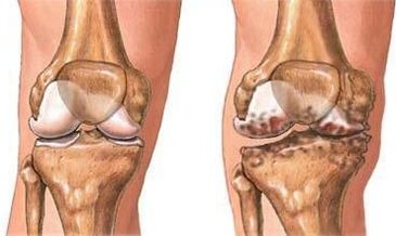 Arthrosis of the knee