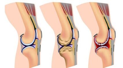Three degrees of severity of the disease
