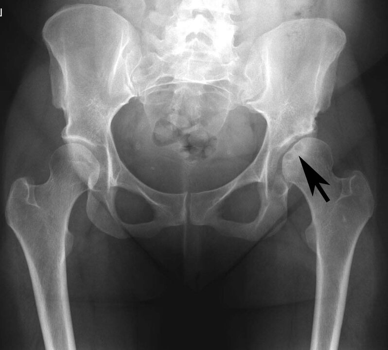 Deposition of calcium salts in the hip joint with pseudogout on an x-ray