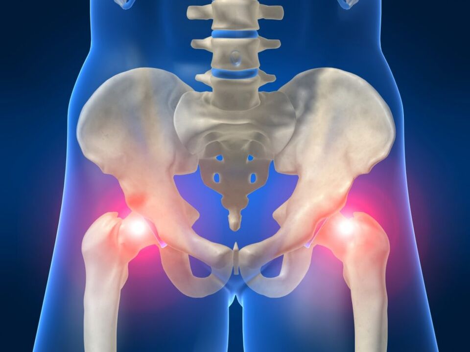In ankylosing spondylitis, bilateral pain in the hip joint is disturbing